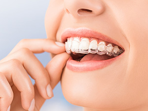 Invisalign ya da şeffaf plak tedavisi ile dişlerin düzeltilmesi