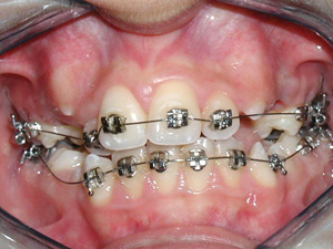 Ortodontik Bozukluk Nedenleri?