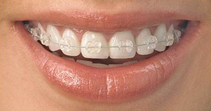 Ortodontik tedavi maliyeti